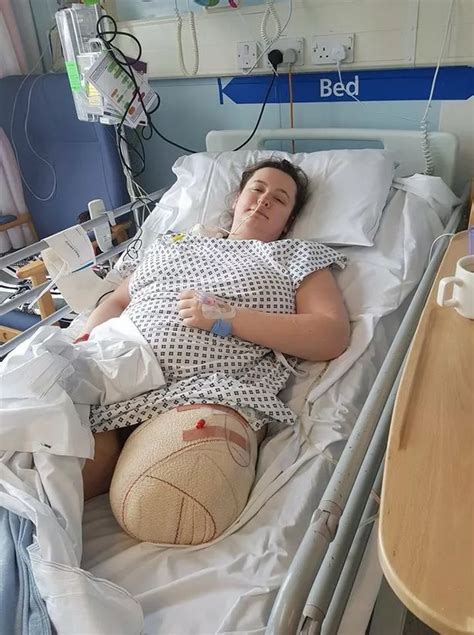 The woman had a leg amputated in an accident .
